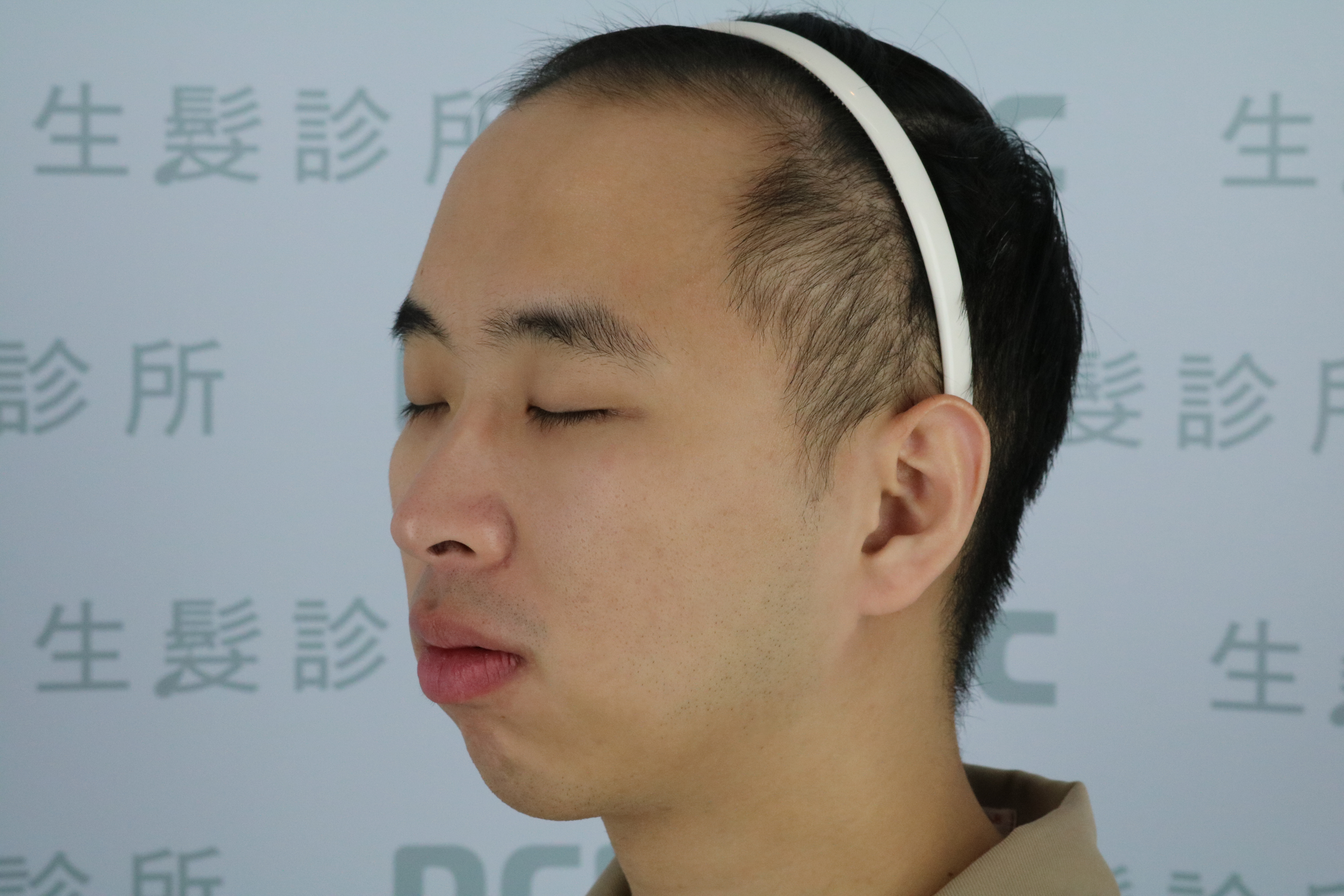 DCDC生髮診所-男性前額髮際線稀疏與額角後縮術前正面檢視
